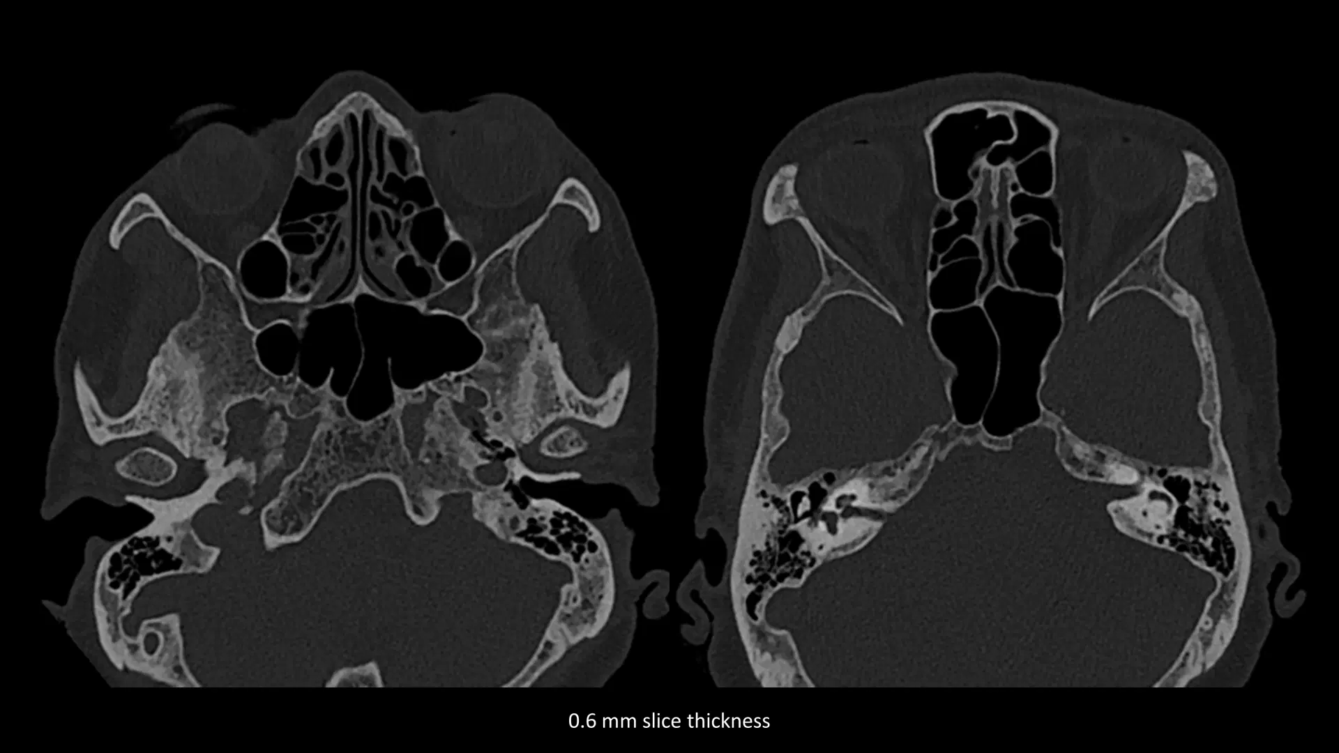 Sample Head and neck CT Scan